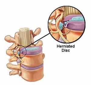 Disc bulge in neck