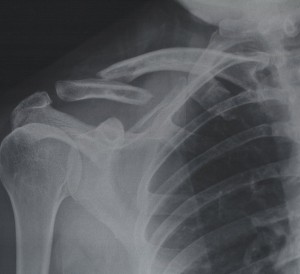 Resveratrol can increase bone density