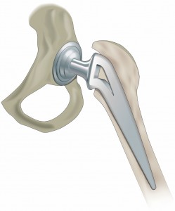 hip replacement and exercise